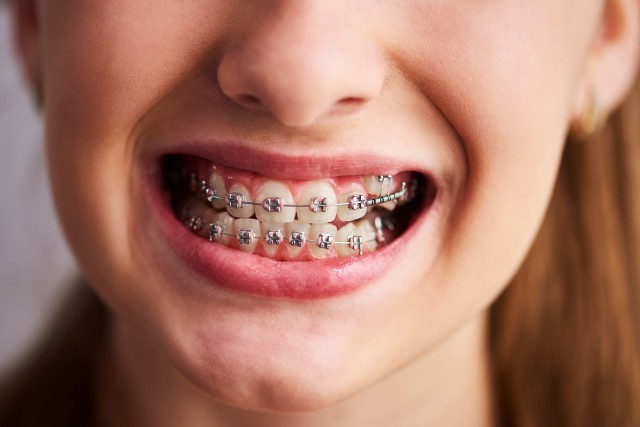 Aparat na zęby tylko dla dzieci? Wcale nie. Piękny uśmiech możesz mieć w każdym wieku. Musisz tylko spełnić te warunki