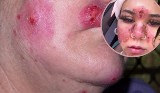 Twarz kobiety spuchła i pokryła się ranami! Lekarka dermatolog ostrzega przed tym błędem w pielęgnacji
