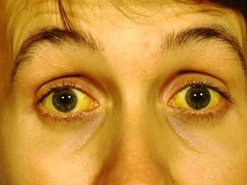 Żółtaczka, czyli wyraźne zażółcenie się oczu oraz skóry