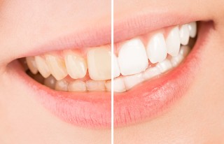 Polecane i skuteczne sposoby na wybielenie zębów