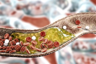 Podejrzewasz, że masz wysoki cholesterol? Zwróć uwagę na te 3 części ciała